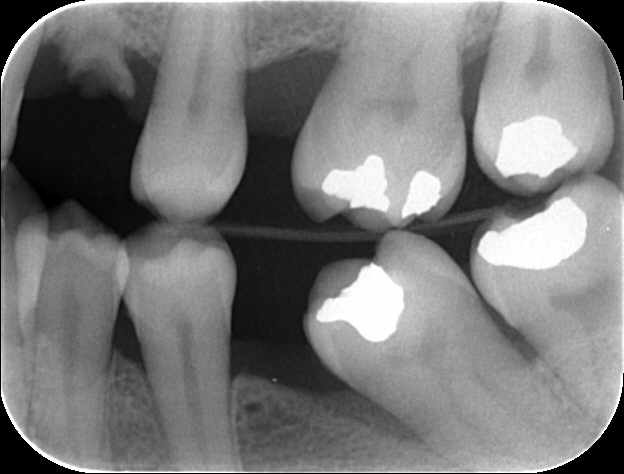 Reabsorción externa en un molar. Evolución en menos de 1 año