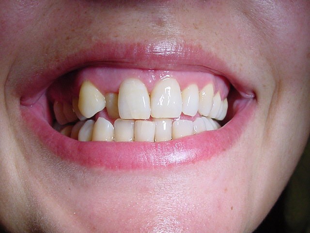 Pseudo-ortodoncia realizada en dos únicas citas: Endodoncia+Gingivectomía y reconstrucción con vestibulización de la pieza