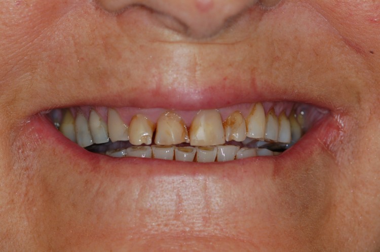 Solución estética con máscara gingival, alargamiento quirúrgico de las coronas dentarias y colocación de seis coronas en zirconio-porcelana