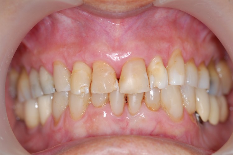 Solución estética con máscara gingival, alargamiento quirúrgico de las coronas dentarias y colocación de seis coronas en zirconio-porcelana