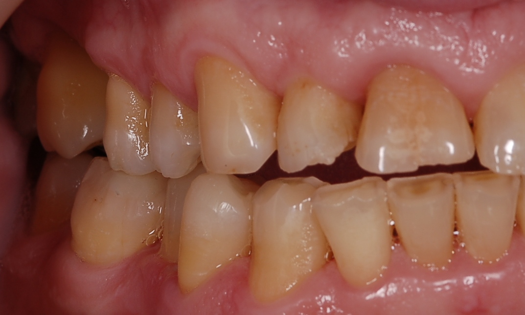 Paciente con grandes desgastes en sus piezas dentarias. Rehabilitación muy conservadora mediante una modificación de la técnica de los tres pasos