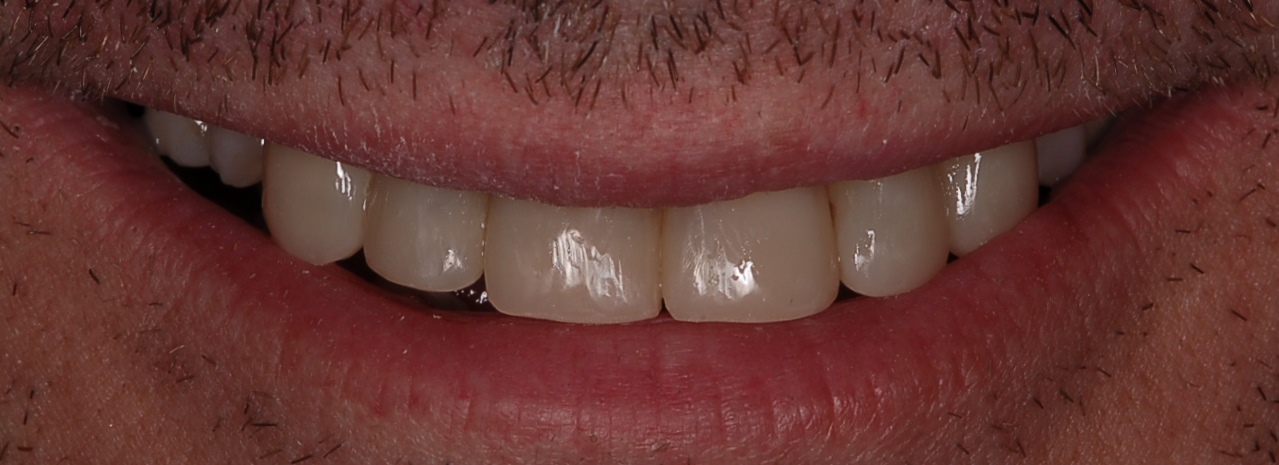 Paciente con grandes desgastes en sus piezas dentarias. Rehabilitación muy conservadora mediante una modificación de la técnica de los tres pasos