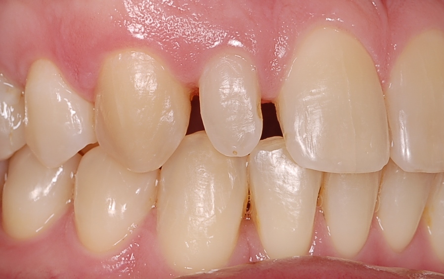 Tratamiento multidisciplinar: ortodoncia+blanqueamiento+reconstrucciones directas de composite. Aspecto un año después