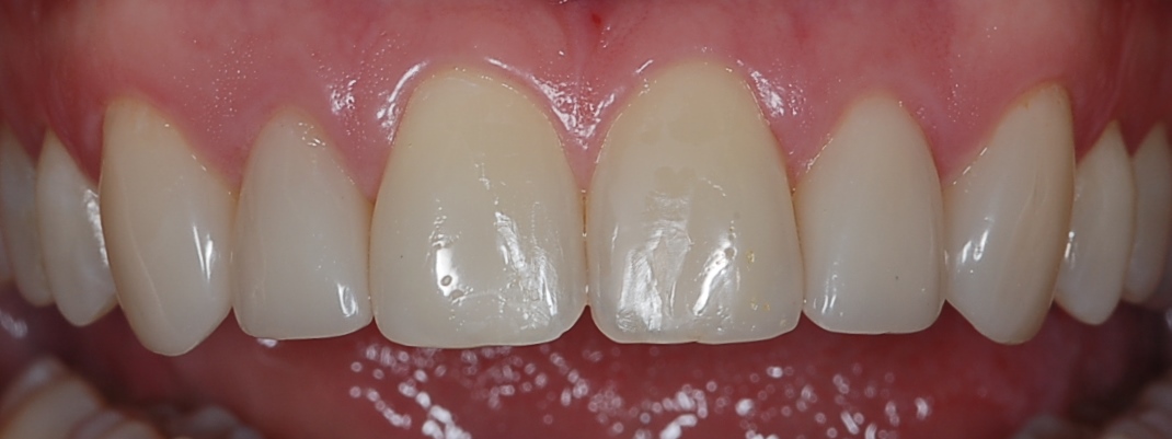 Tratamiento multidisciplinar: ortodoncia+blanqueamiento+reconstrucciones directas de composite. Aspecto un año después
