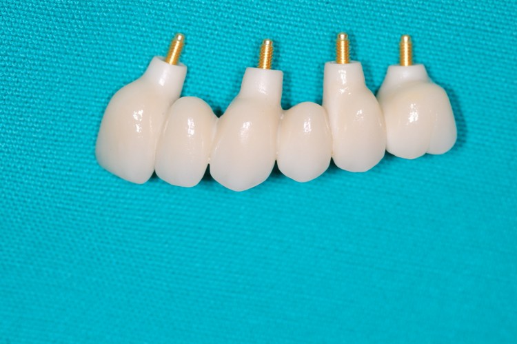 Prótesis sobre implantes en zirconio-pocelana en el segundo cuadrante