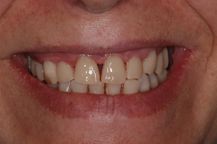 Rehabilitacion completa atornillada en maxilar superior sobre ocho implantes. Imágenes con provisionales inmediatos en resina y con la prótesis ceramometálica definitiva