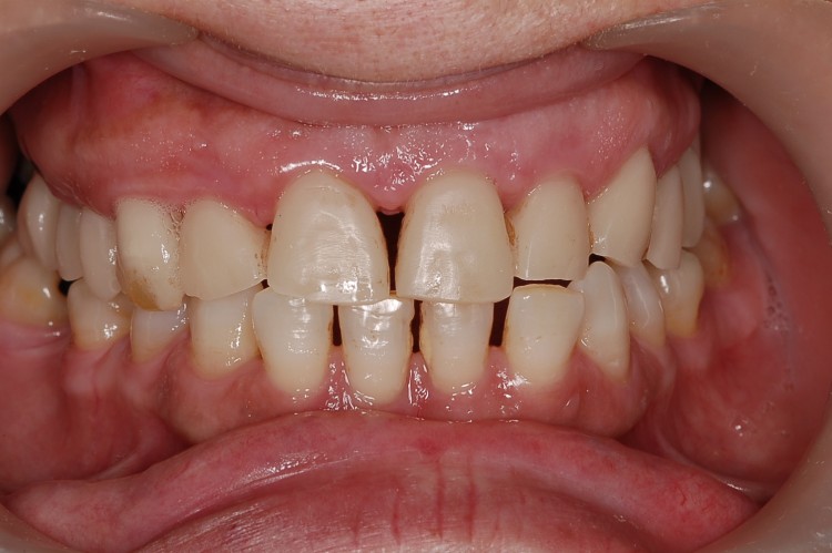 Rehabilitacion completa atornillada en maxilar superior sobre ocho implantes. Imágenes con provisionales inmediatos en resina y con la prótesis ceramometálica definitiva