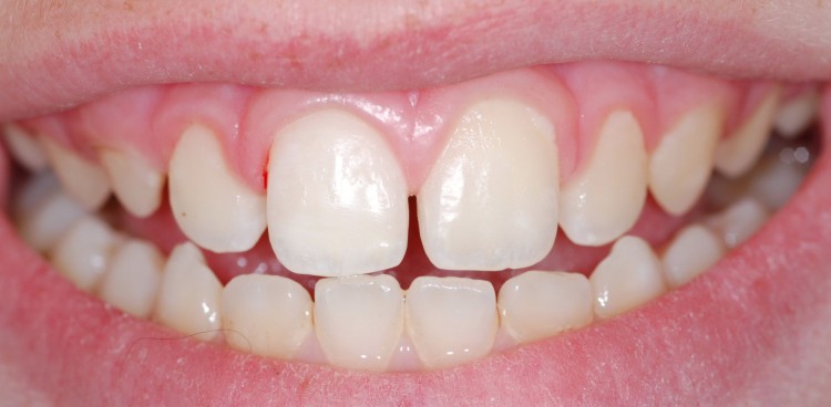 Reposición de fragmentos en una doble fractura dentaria (es importante recogerlos y meterlos en suero, leche, ó la misma boca del paciente)