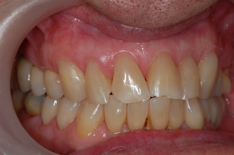 Obturación de múltiples erosiones dentarias