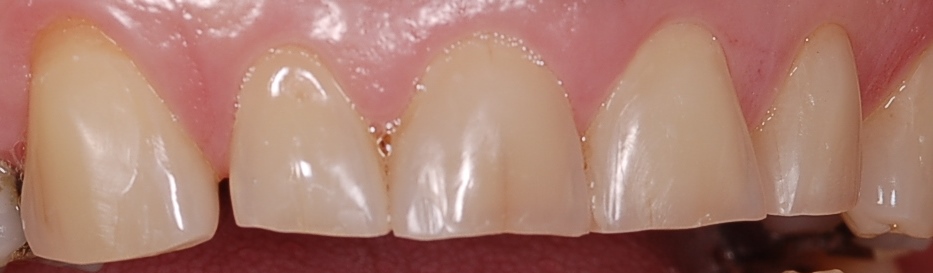 Obturación de múltiples erosiones dentarias
