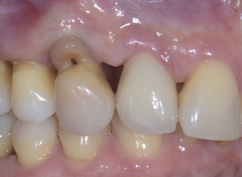 Resultado de erosiones dentarias sin tratar: afectación culpar