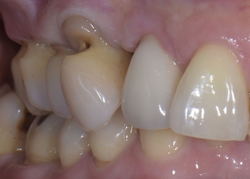 Resultado de erosiones dentarias sin tratar: afectación culpar