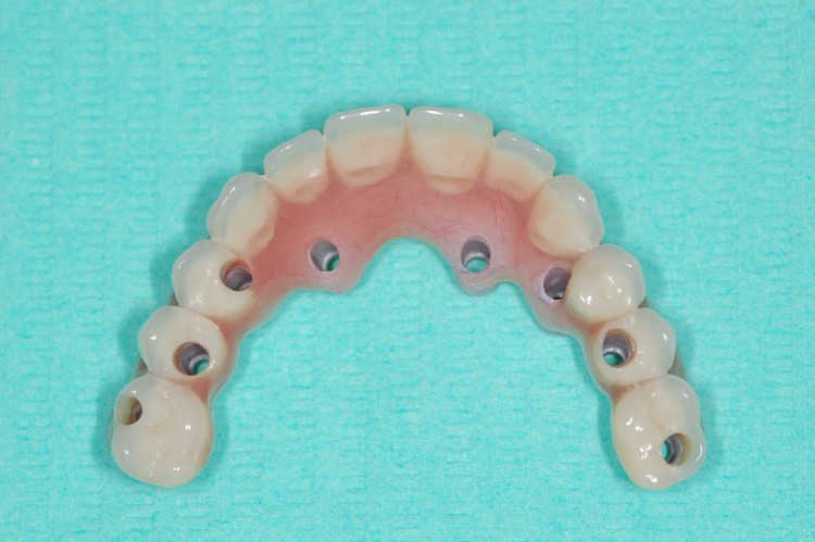 Prótesis fija híbrida (zirconio-resina) sobre 8 implantes en maxilar superior