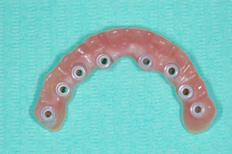 Prótesis fija híbrida (zirconio-resina) sobre 8 implantes en maxilar superior