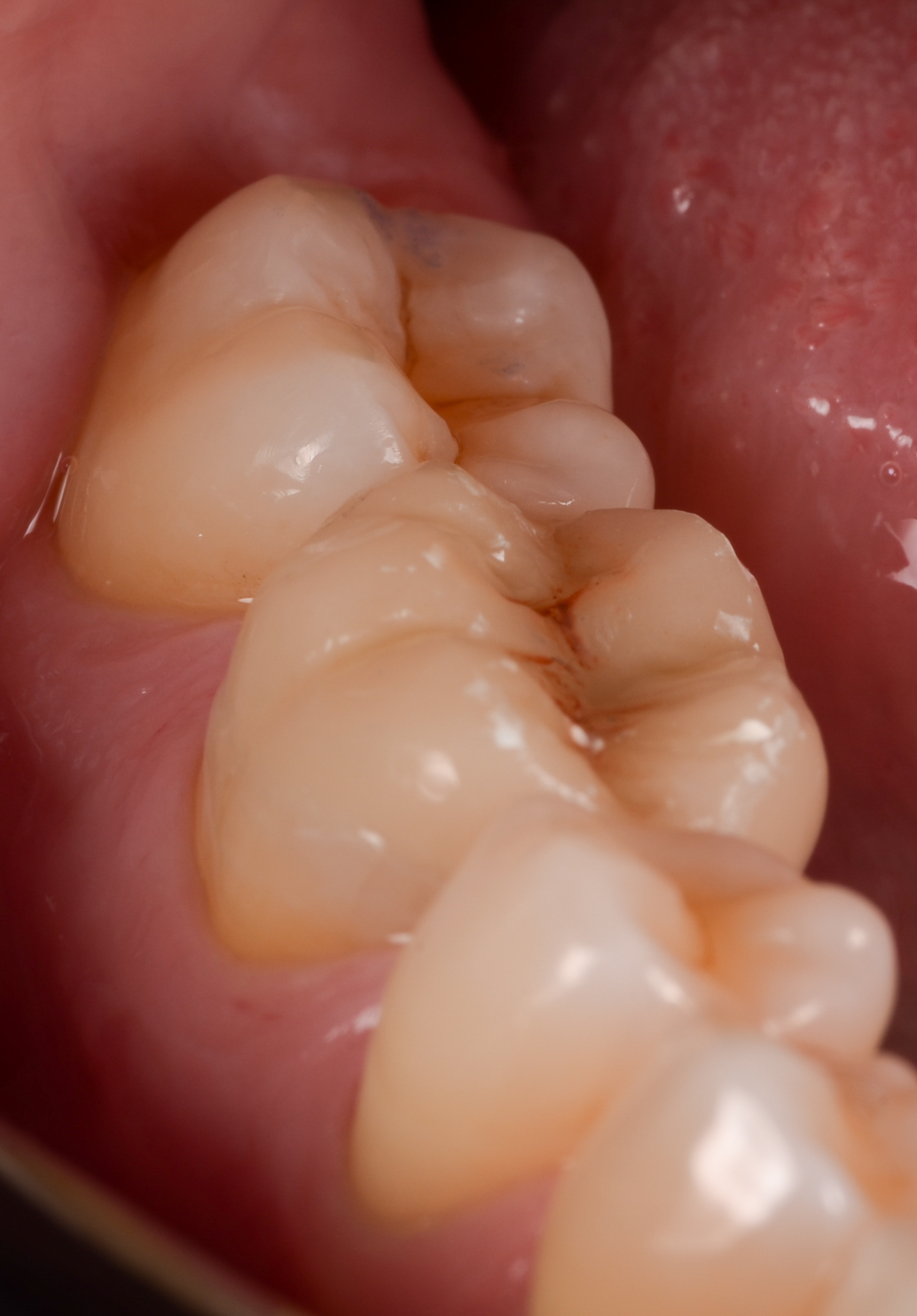 Incrustación (overlay) de cerámica infiltrada con polímeros (vita enamic)  en molar inferior derecho