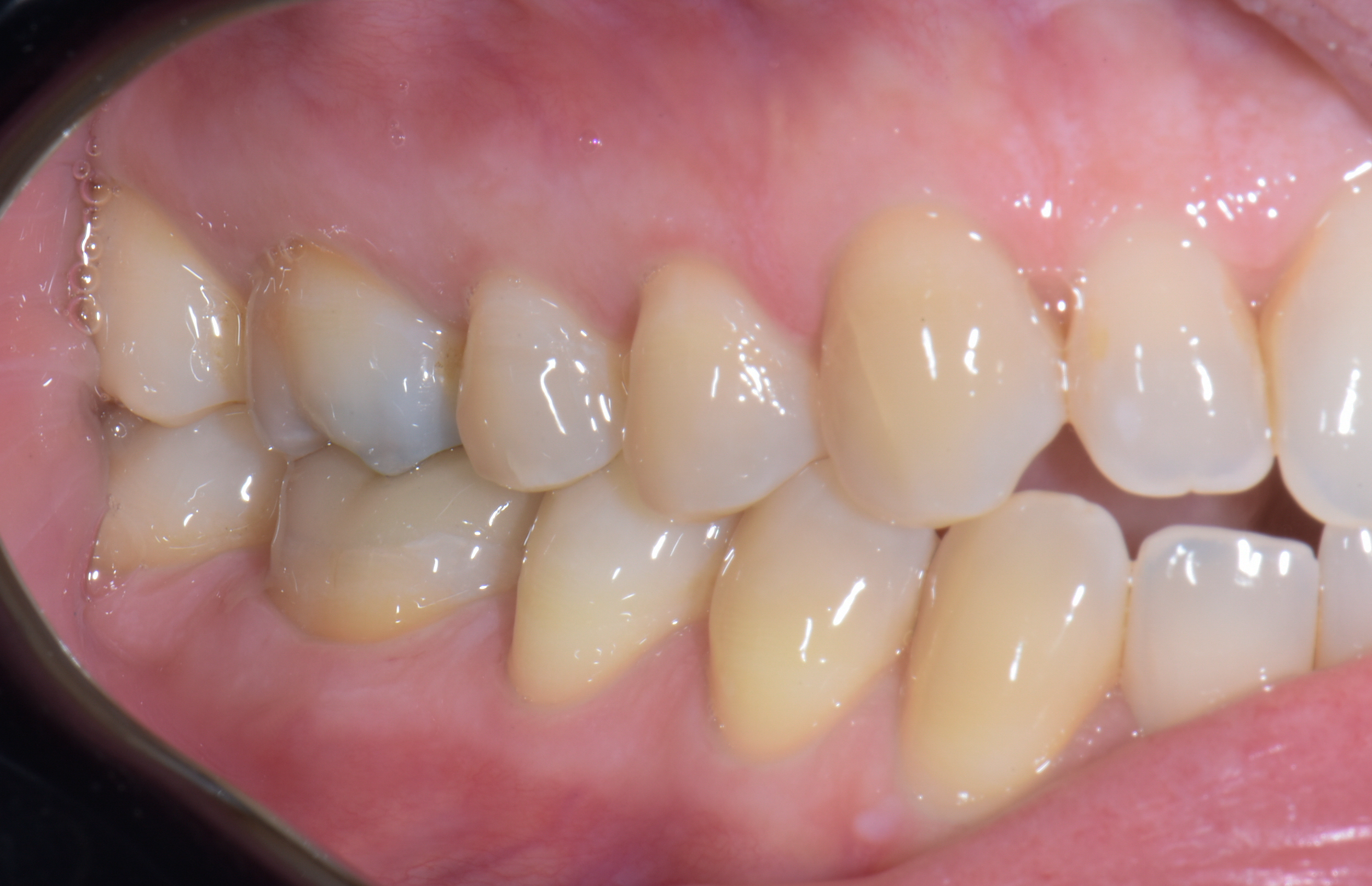 Incrustación (overlay) de cerámica infiltrada con polímeros (vita enamic)  en molar inferior derecho