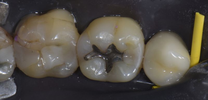 Incrustación (overlay) de cerámica infiltrada con polímeros (vita enamic)  en molar inferior derecho, con detalle de los pasos a seguir