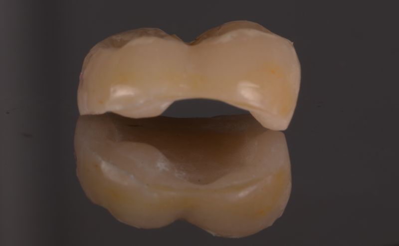 Incrustación (overlay) de cerámica infiltrada con polímeros (vita enamic)  en molar inferior derecho, con detalle de los pasos a seguir