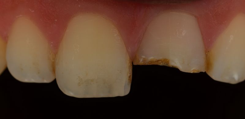 Corona de cerámica suprinity en incisivo central izquierdo